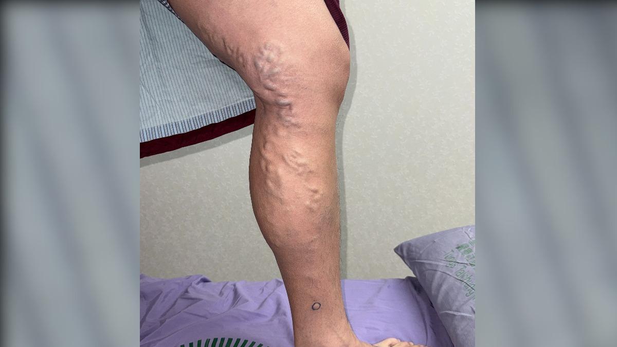 再拖恐截肢!台中警「腳冒恐怖蚯蚓」 5類人全是高風險