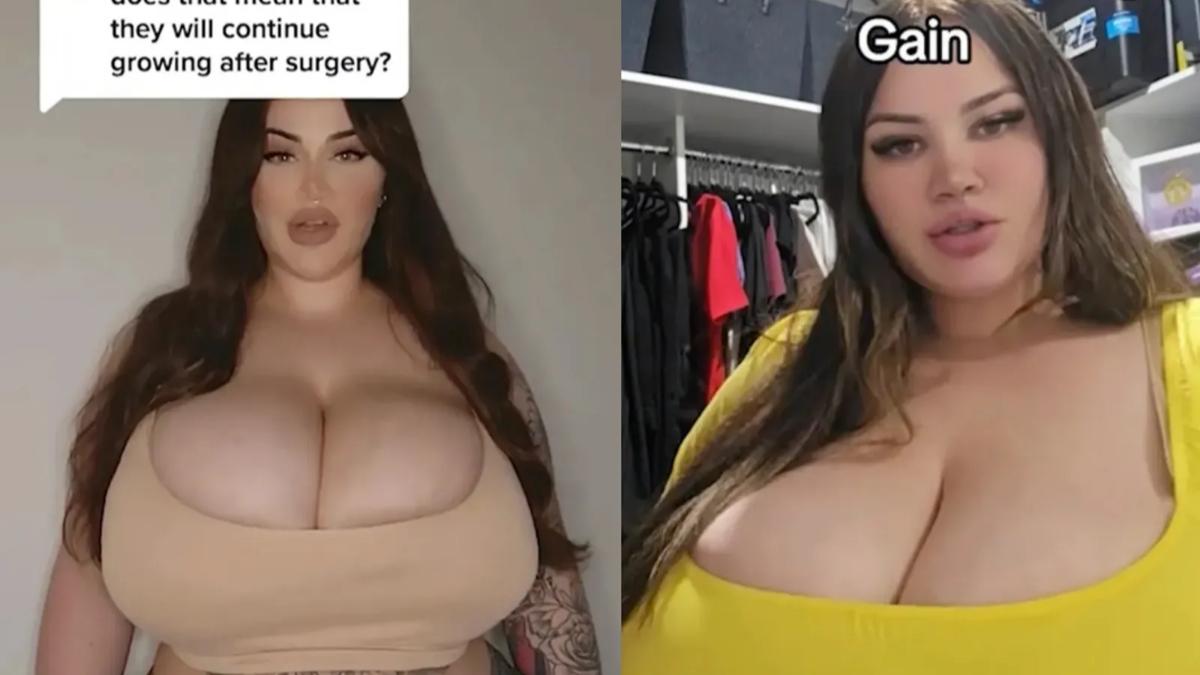 巨乳症女崩潰胸持續長大「無法呼吸」 醫一理由拒縮胸