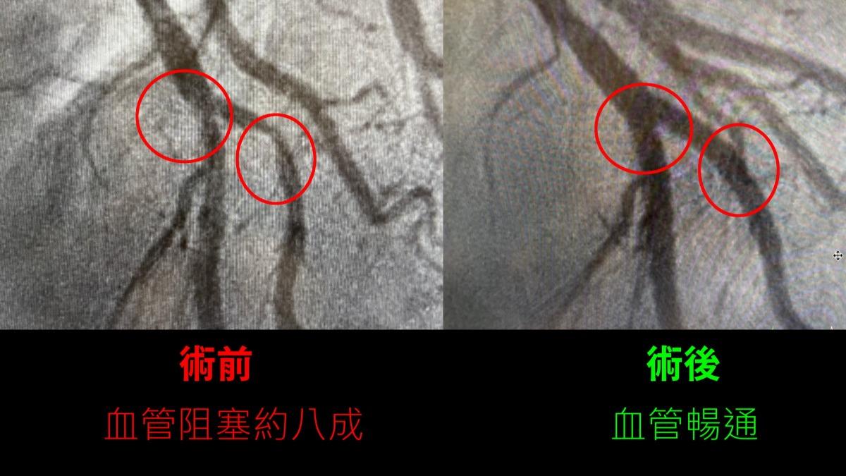 不菸不酒!7旬翁呼吸困難喘不停 一查「冠狀動脈硬化」