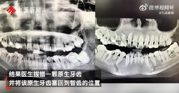 醫師又將好牙塞入智齒的洞中。(圖/翻攝自微博)