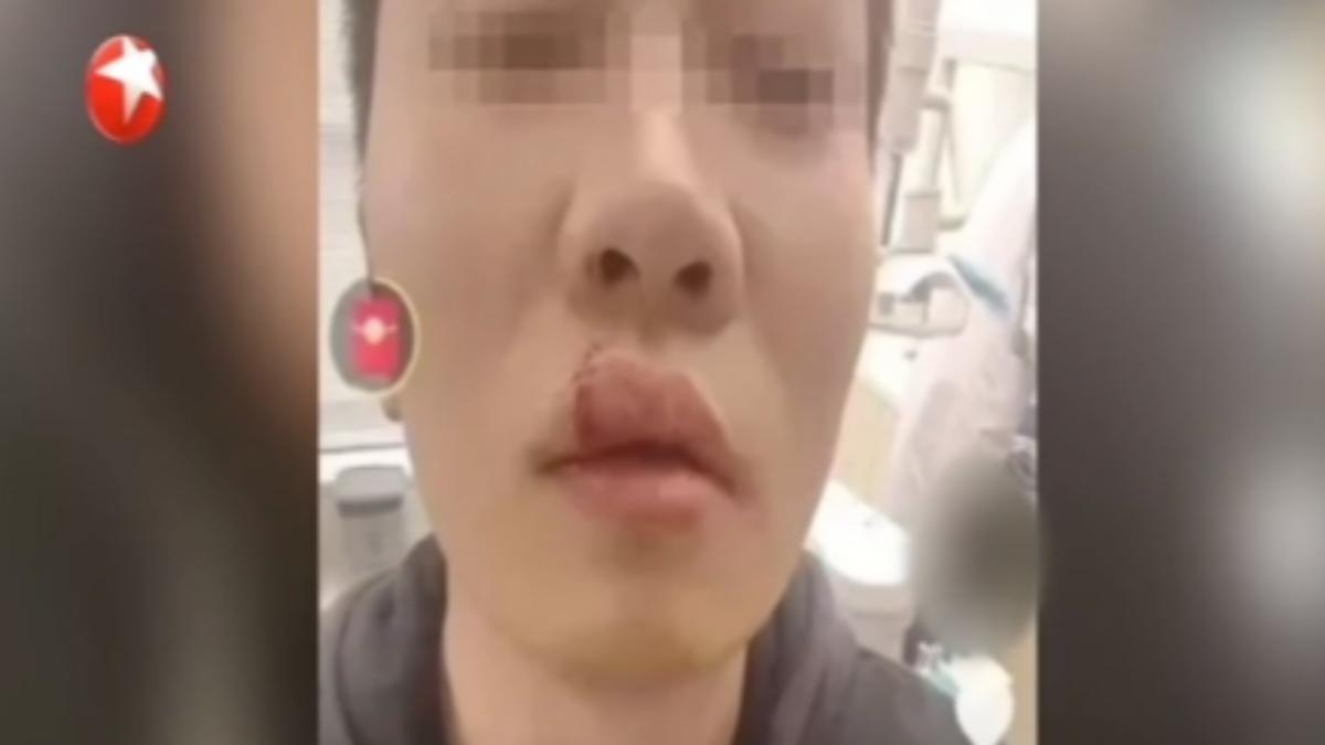 拔起電動車充電槍一瞬間，充電槍就高速反彈砸向臉部，男車主事後發文說被充電槍「打臉」，嘴唇縫了八針，牙齒都差點斷了。（圖／上海東方衛視）