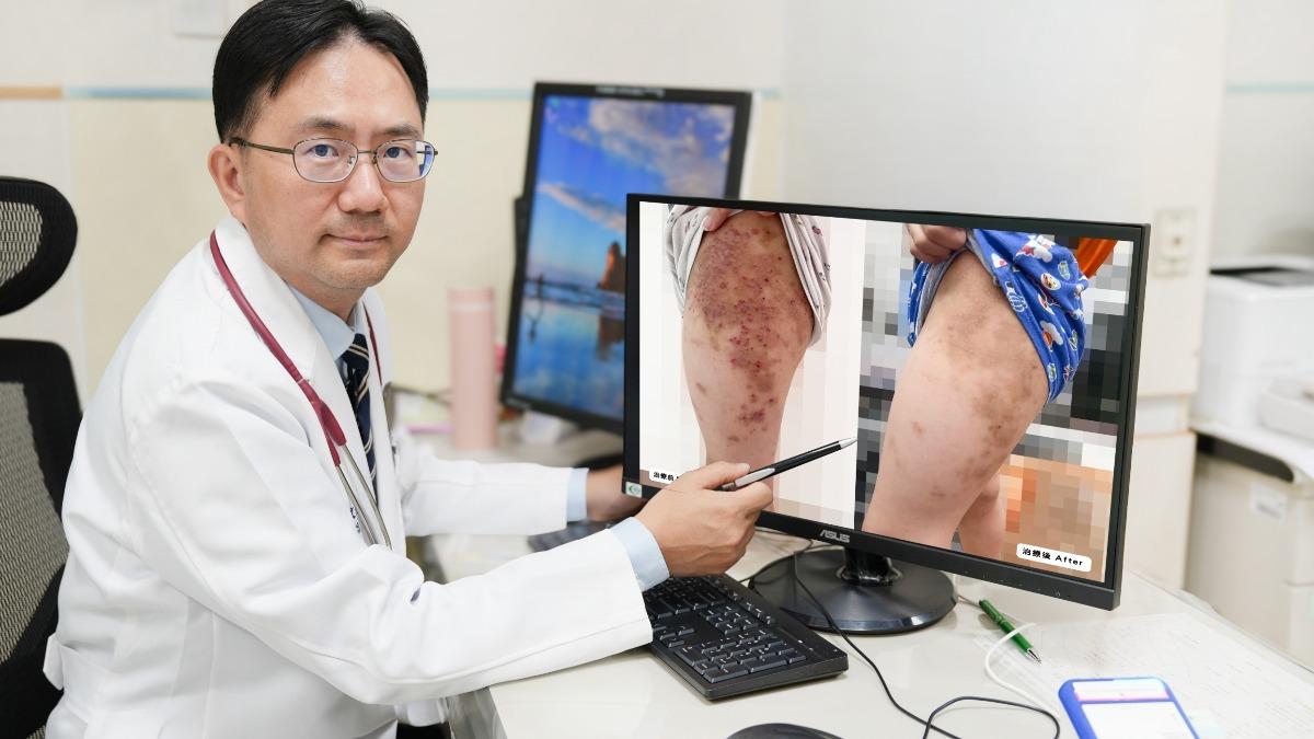 楊樹文採取口服免疫抑制劑及外用類固醇藥膏治療,並協助男童申請療程。(圖/中國附醫兒童醫院提供)