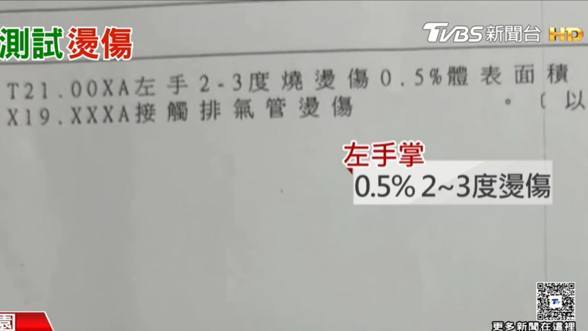 男子左手掌因「接觸排氣管燙傷」有2-3度燙傷。（圖／TVBS）