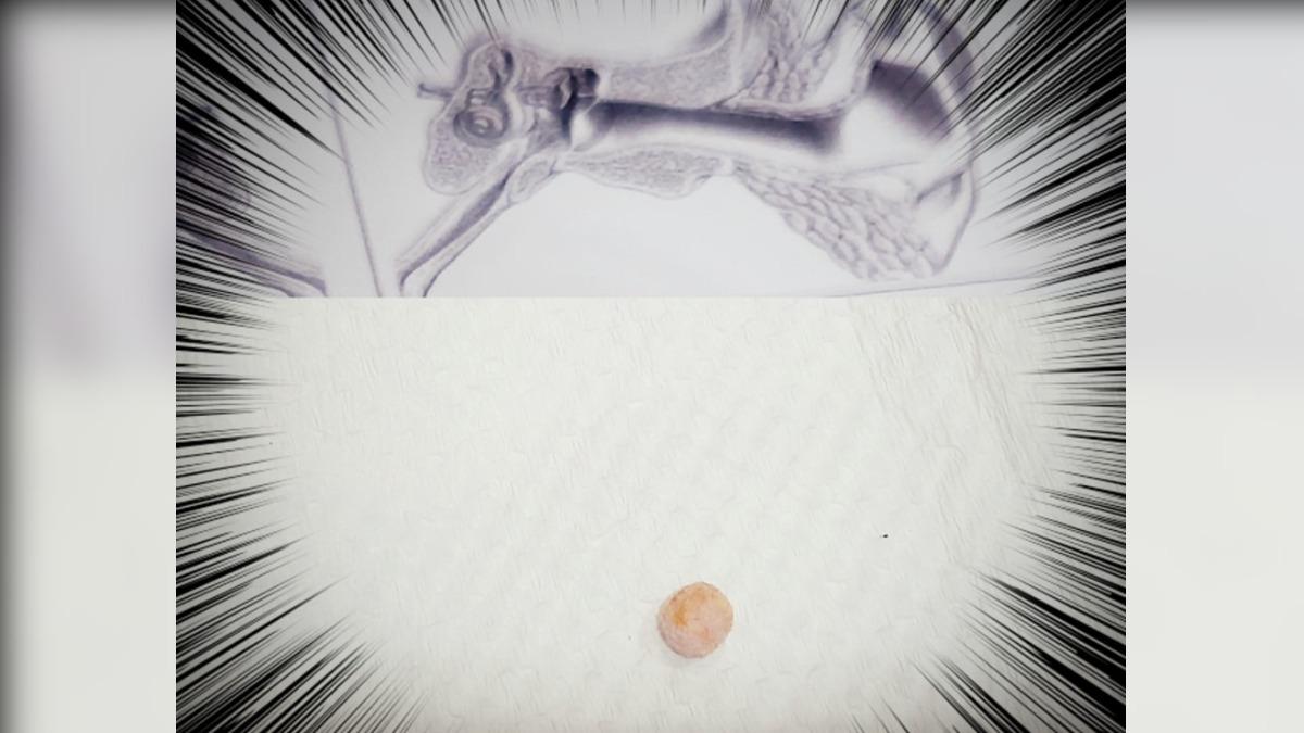 9歲女童喊「耳朵有東西」卻不痛!母親以為開玩笑 醫一夾秒愣