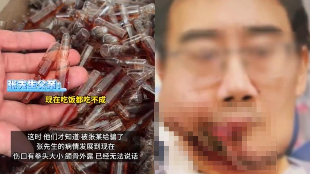 中國大陸-口腔癌-中醫-半張臉消失