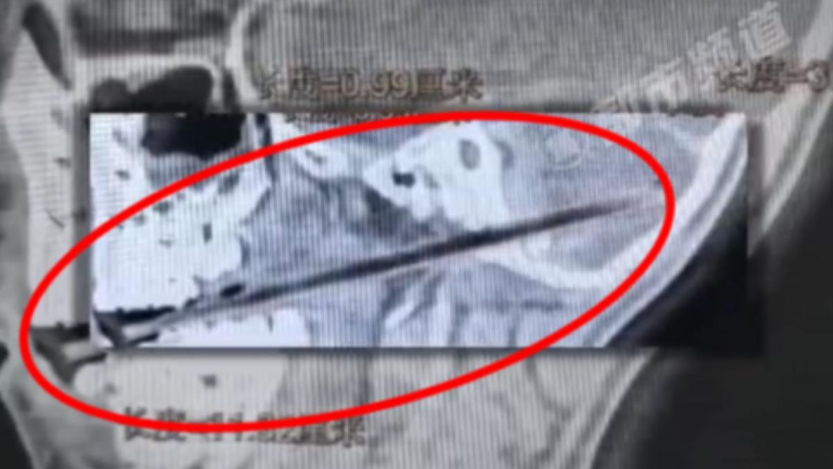 竹籤貫穿小朱顱底、深入小腦,情況相當危急。(圖/翻攝自微博)