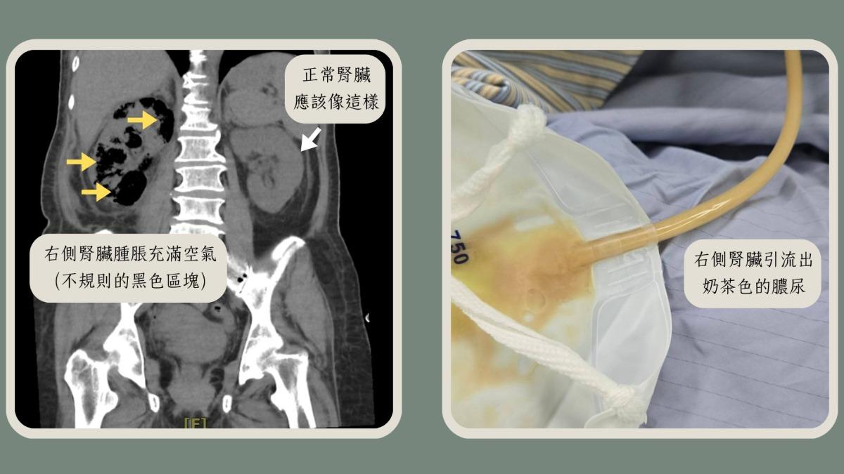 死亡率高達25%!糖尿病自行停藥 恐併發「這種腎臟病」
