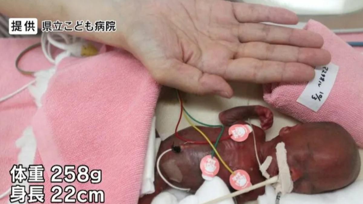 關野龍佑出生時僅258克,比成人手掌還小。(圖/翻攝X@FNN_News)