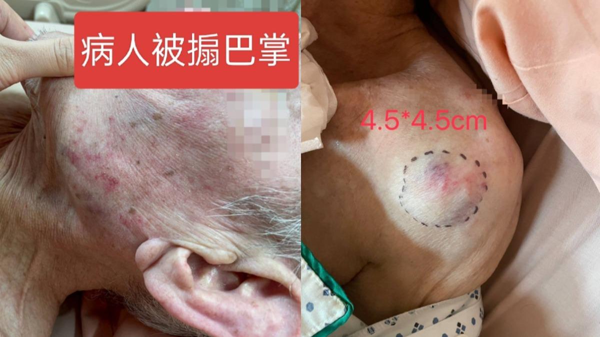 惡看護出拳狂搧巴掌!阿伯哭「不要打我」求饒 全身傷醫治
