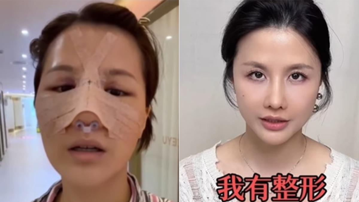 遭狂酸「鼻子變形」!台灣女歌手認了整形 曝術後照吐心聲