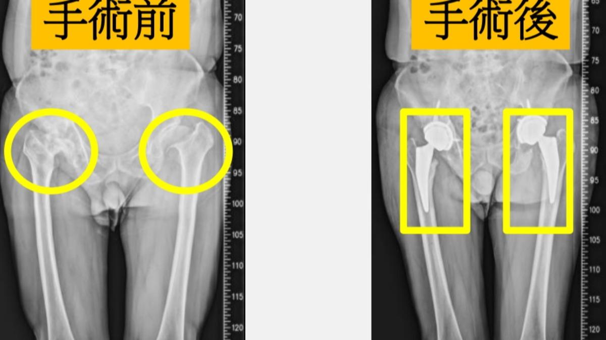 以為拉傷!郵差1部位缺血壞死釀劇痛關節炎 怕丟工作忍3年