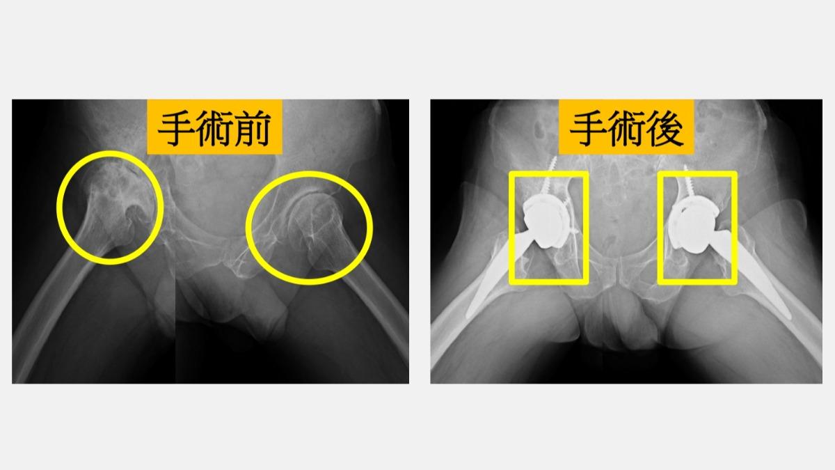 李男術後6小時就開始用助行器下床活動,2個月後順利回到工作崗位。(圖/大里仁愛醫院提供)