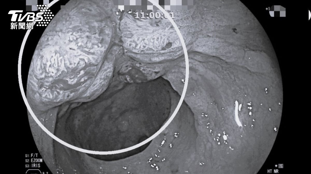 南投八旬翁血便腹痛罹胃癌 醫「這招」妙手免挨刀切胃