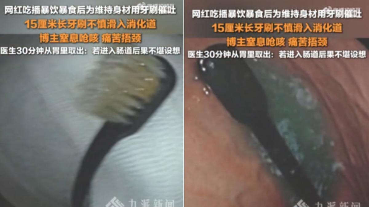 吃播後催吐!陸網紅「手滑吞下15公分牙刷」 醫看傻:掉進胃裡