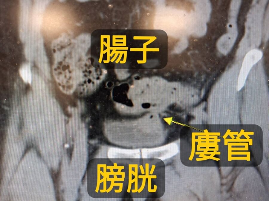 恐怖泡泡尿藏危機。( 圖/翻攝自戴定恩醫師臉書)