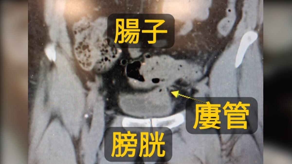 6旬男上廁所驚見「泡泡尿」！醫一查嚇傻：腸子接到膀胱了