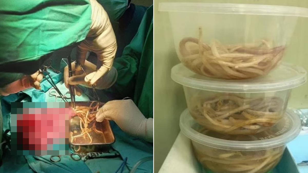 慎入！印尼男童腹脹便秘求醫　剖腹噴出「巨量蛔蟲」裝3碗公