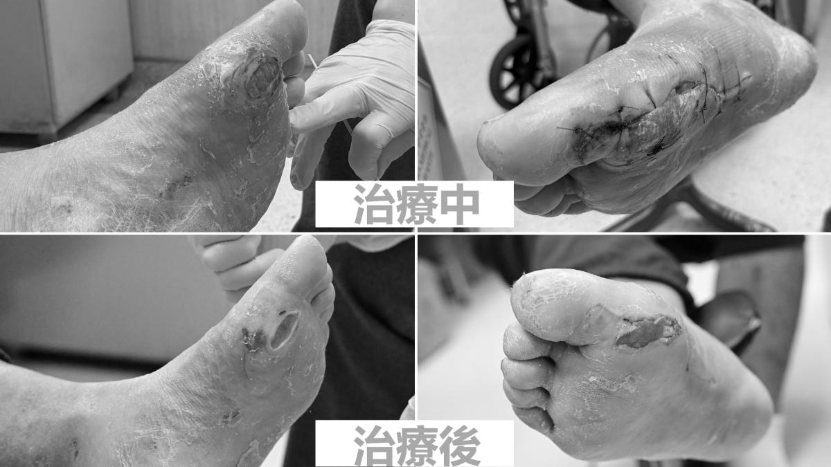 台中百斤男突腳痛!腳底皮掉整片「白襪變紅襪」 驚悚畫面曝