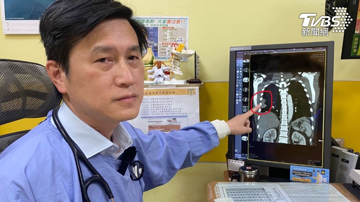 員榮醫院醫療副院長涂川洲表示,患者感上類鼻疽菌,肺部有兩處膿瘍。(示意圖/TVBS)