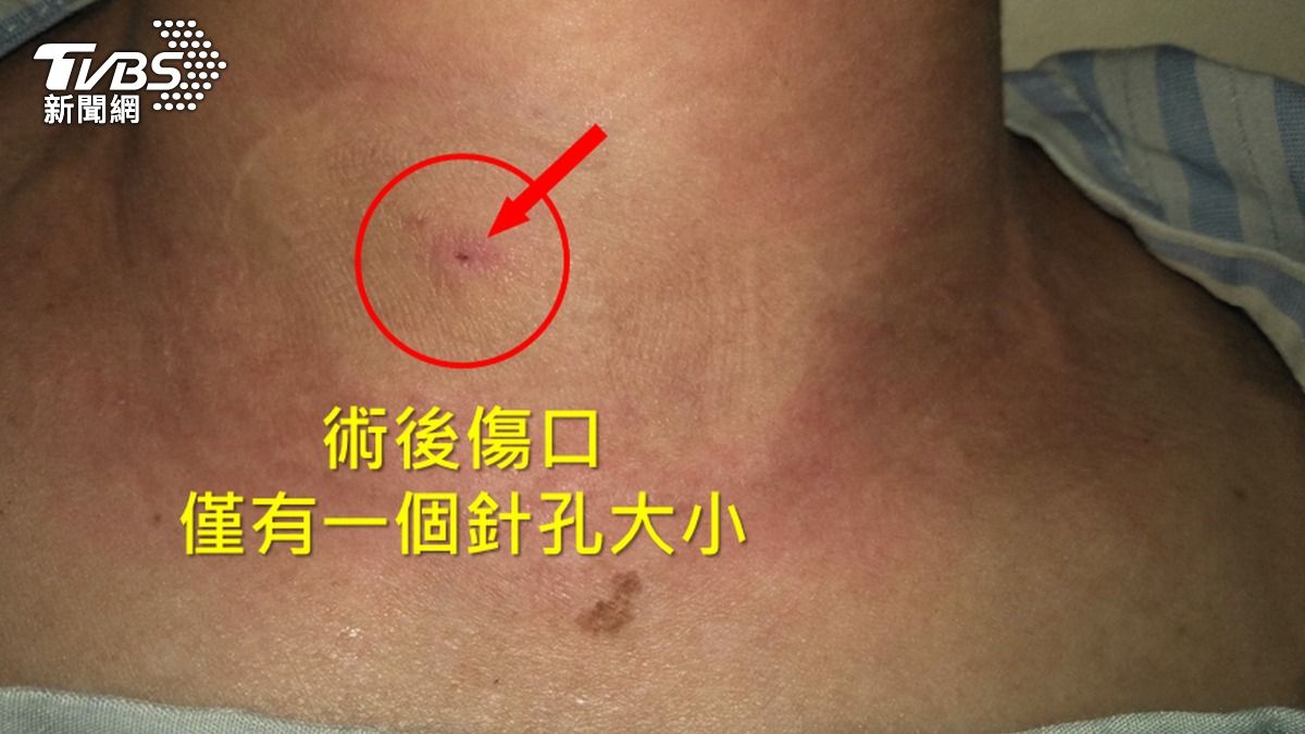 粉領族脖子長腫瘤 醫妙手「消融術」免切除甲狀腺隔天即出院