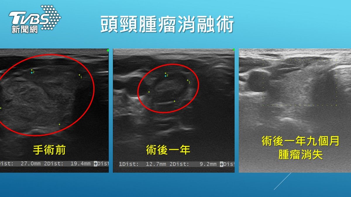 術後一年九個月腫瘤消失。(圖/TVBS)