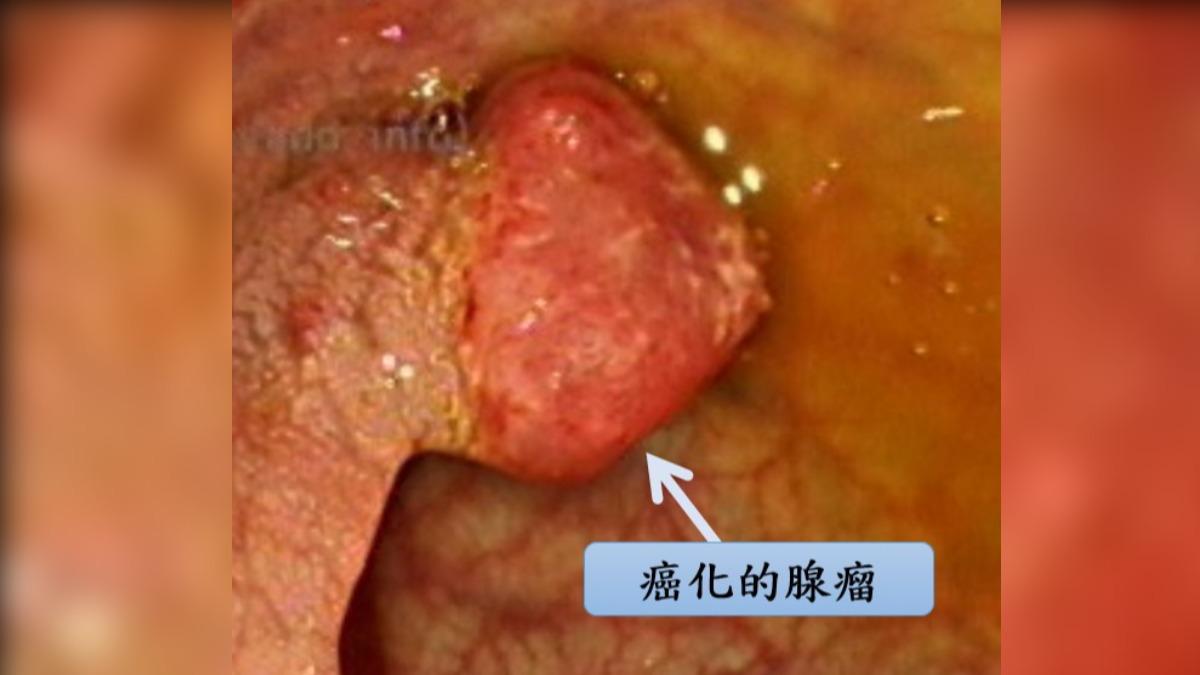 醫「三個雞婆」揪出大腸癌 台積電女員工淚謝:救了我一命