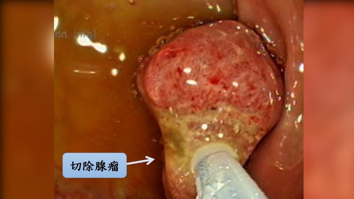 直腸裡有一個1公分的腺瘤性息肉。(圖/翻攝許秉毅臉書)