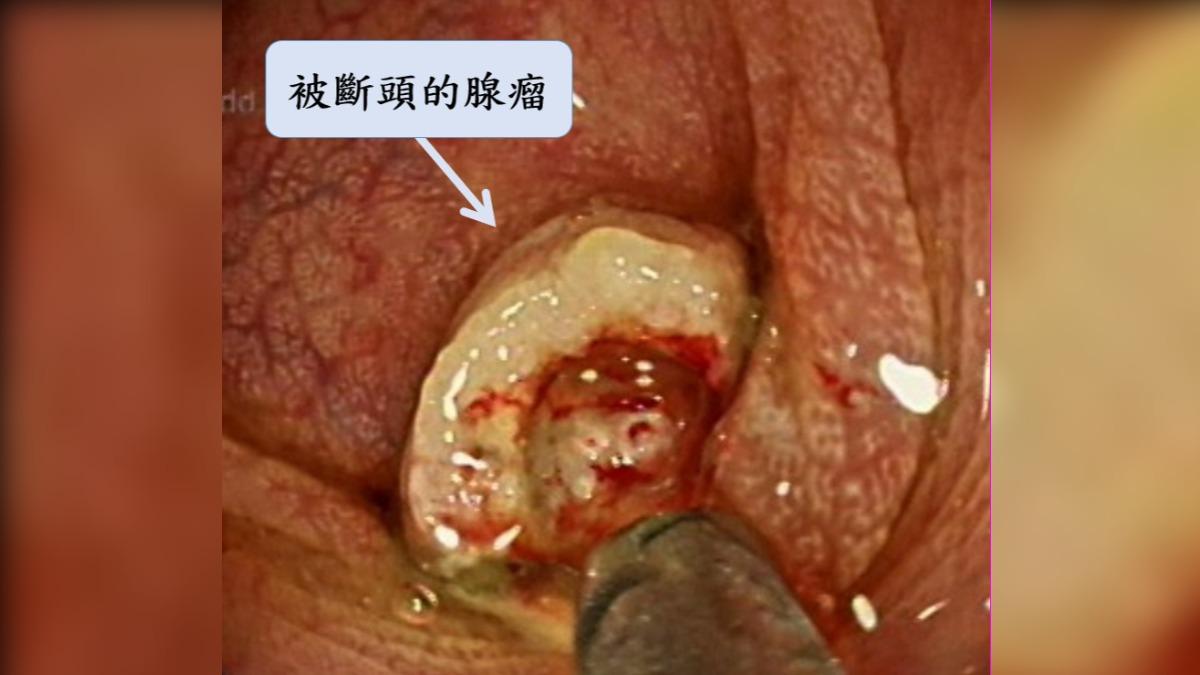 直腸裡有一個1公分的腺瘤性息肉。(圖/翻攝許秉毅臉書)
