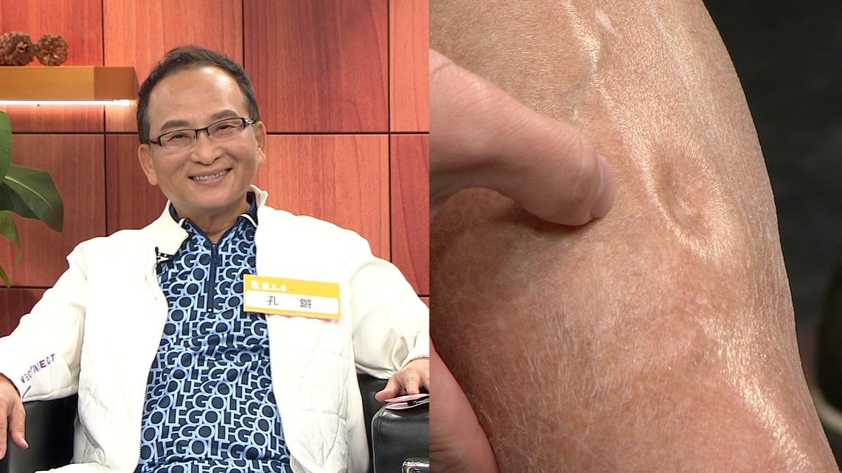 孔鏘罹怪病「右腿凹一個洞」驚悚畫面曝 醫生一看嚇到:恐需葉克膜救命