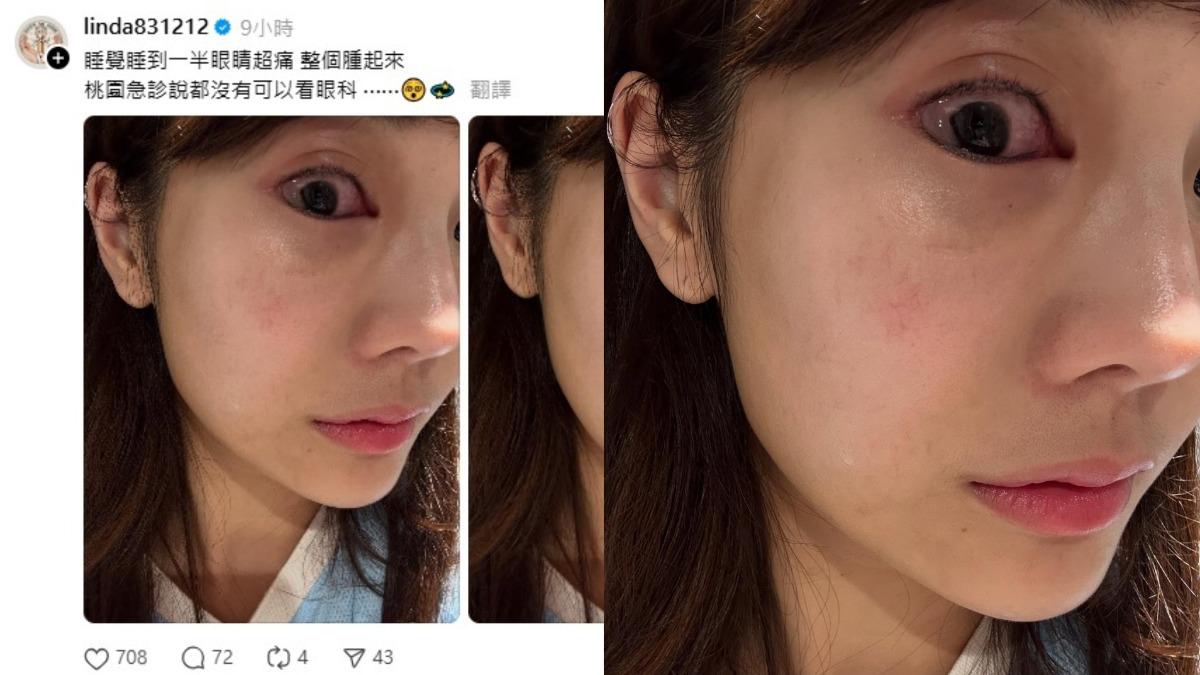 琳妲今(20)日凌晨突然眼部不適,不僅劇烈疼痛、眼球腫脹,甚至在半夜奔波急診卻求助無門,讓她直呼無奈。(圖/翻攝自琳妲Threads)