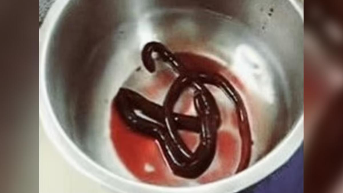 男子尿出一條巨型腎蟲,長約30公分。(圖/翻攝自JCDR)