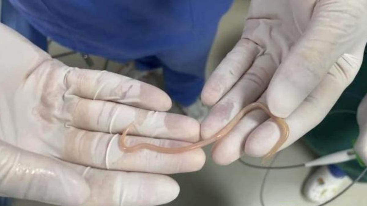 腹痛找嘸原因!陸女照大腸鏡 驚見「10公分白色活蟲」蠕動