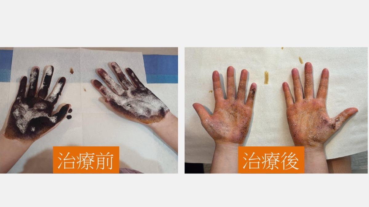 吹冷氣也噴汗!國中妹飄異味不敢靠近友 手抹1物冒紫色斑塊