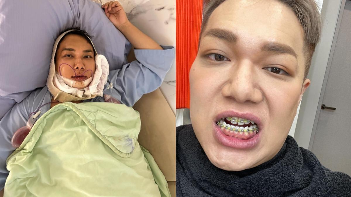 關韶文首次手術後戴了1年牙套,沒想到齒列依舊走位。(圖/翻攝自關韶文IG)