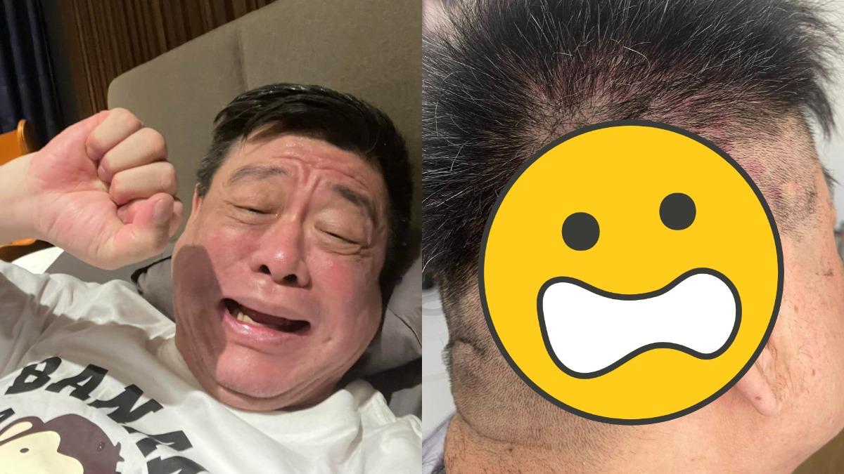 孫德榮頭皮竟佈滿「大小紅斑」 美髮師警告:這牌洗髮精是毒藥