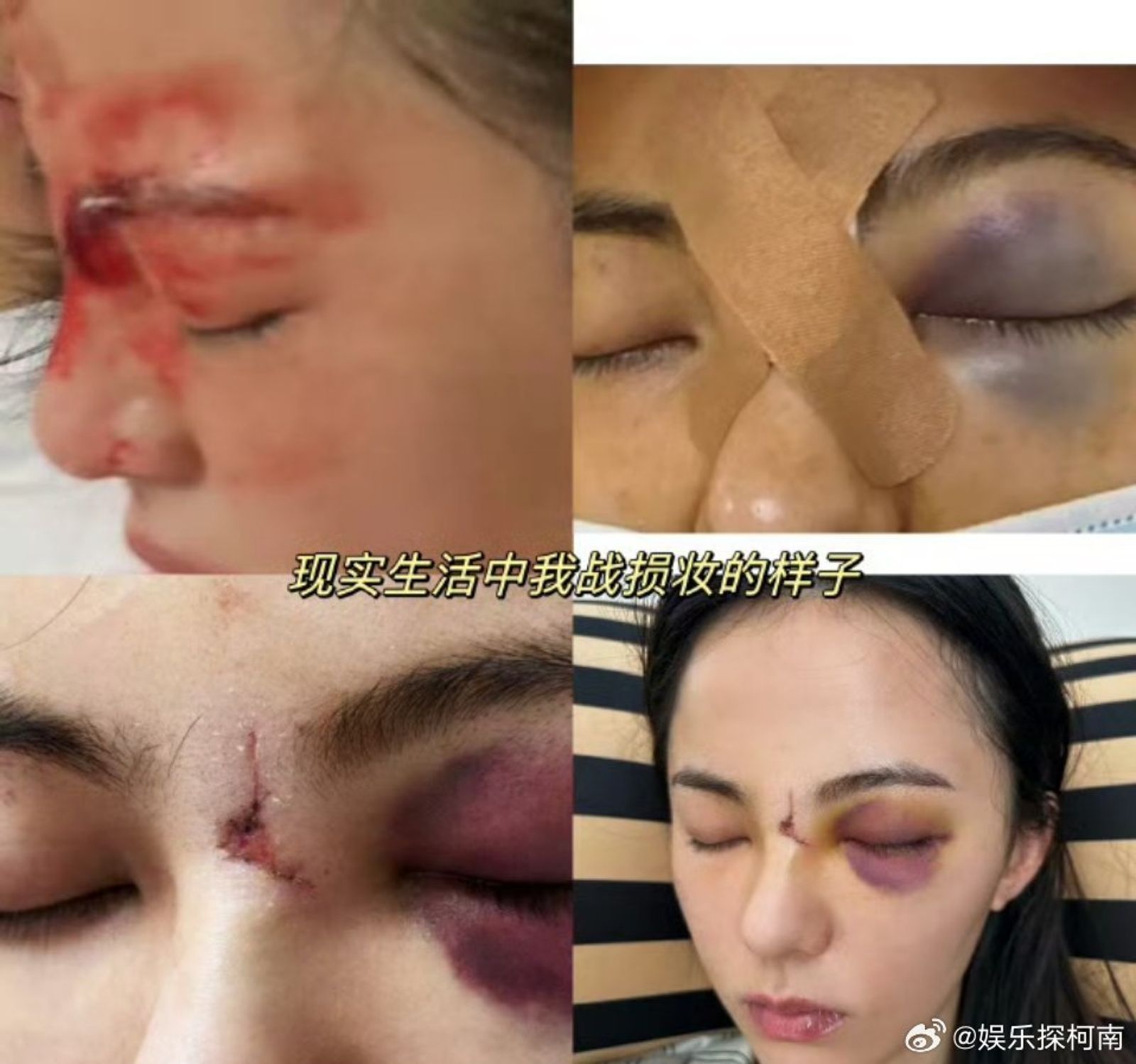 原本演出女二角色的女星黃日瑩武打訓練時臉受傷，竟被踢出劇組，由李凱馨取代。（圖／微博圖片）