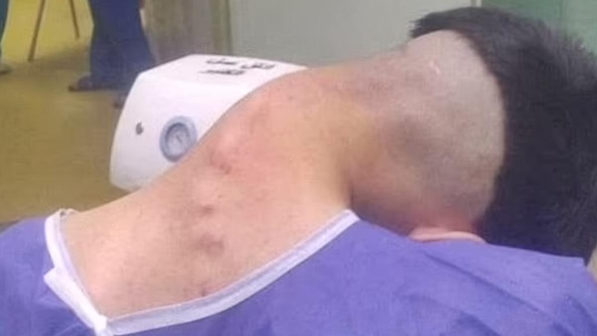 伊朗23歲男染毒脖子「嚴重彎曲呈90度」 罹罕見垂頭症