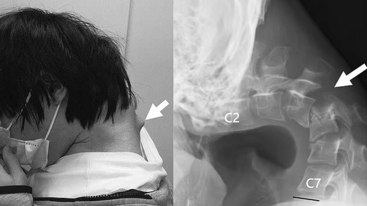 25歲日男低頭狂打手遊 「脖子彎90度」還長詭異突起物
