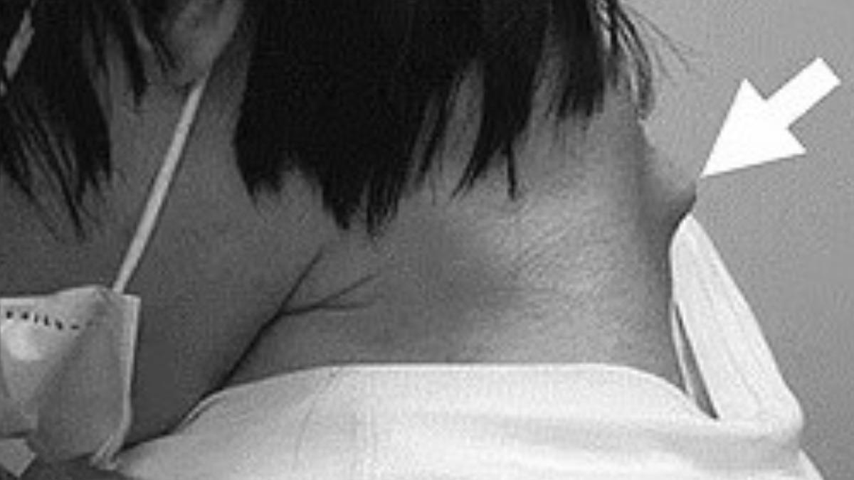 男子的脖子甚至長出突起物。(圖/翻攝自JOS Case Reports)