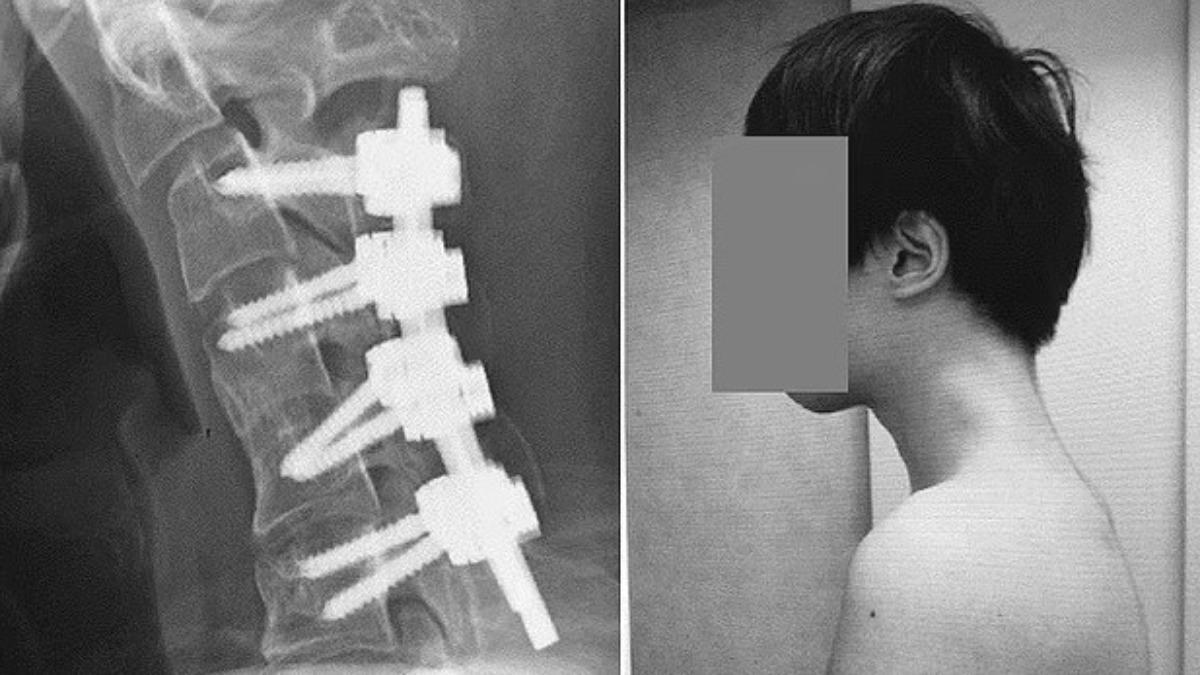 男子動手術6個月後,奇蹟似地能夠輕鬆地將頭部保持在正常水平位置。(圖/翻攝自JOS Case Reports)