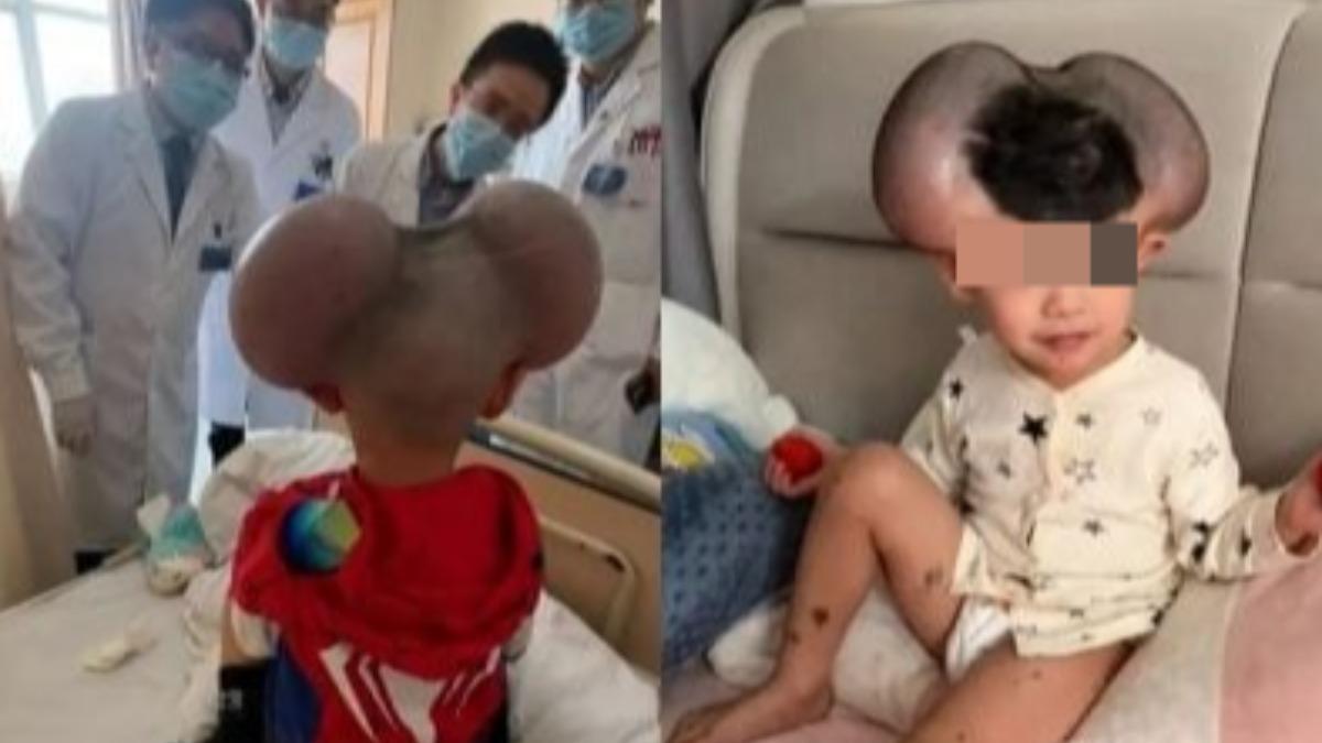 陸3歲童罹罕病!頭長巨痣遭譏「米奇」 手術去除終於笑了