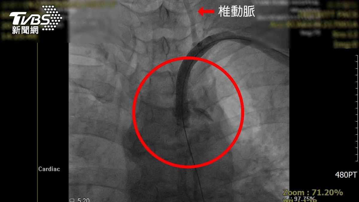 頭暈10年!洗腎婦血管全堵死 一查竟是罕病「竊血症候群」