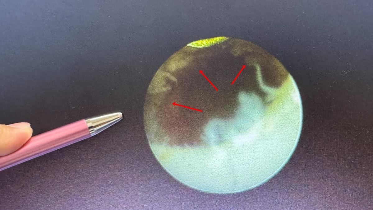 工人距離尿道口2公分的地方，布滿了0.5公分腫瘤（霧狀箭頭處），腫瘤延伸至少4公分。（圖／大甲李綜合醫院提供）