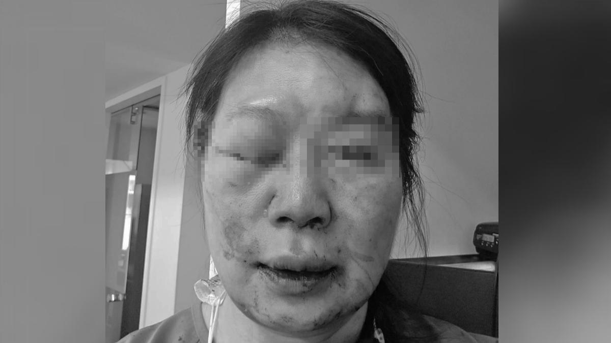女醫師被病患毆打,臉部多處挫傷送醫。(圖/民眾提供)