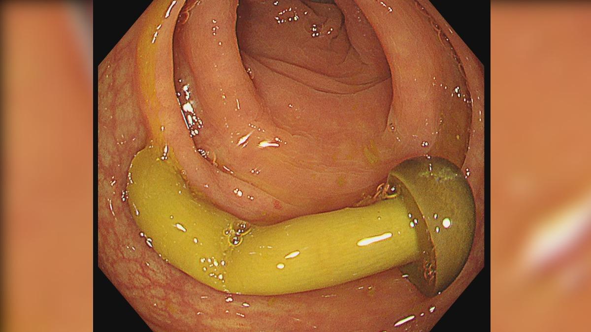 金針菇明天見！照大腸鏡「整朵菇類」掉出來　醫傻眼：吃東西要咬