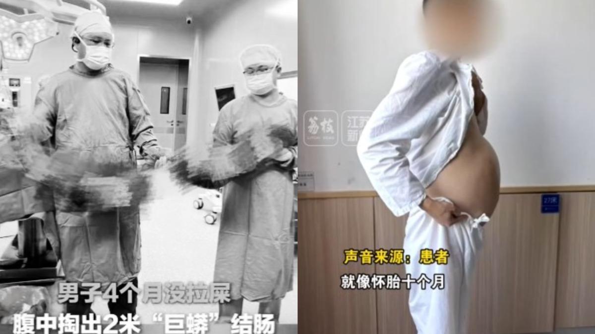 便祕4個月!40歲陸男挺大肚 醫挖出2公尺「巨蟒結腸」