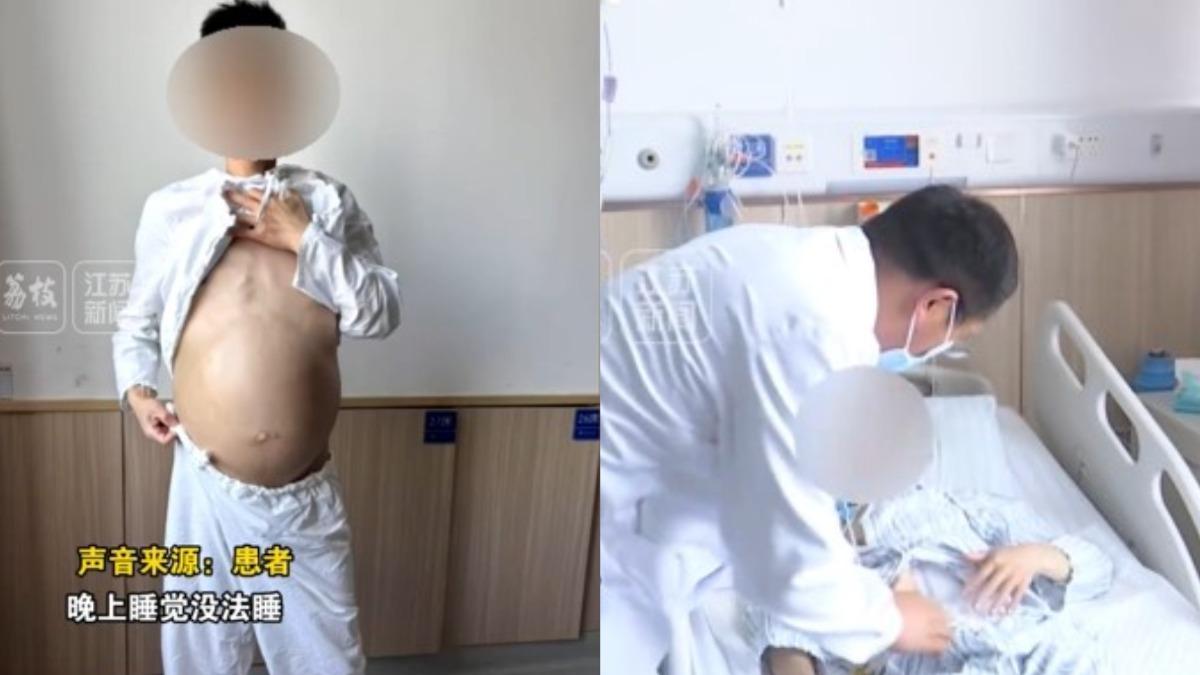 巨結腸-便祕-巨蟒-中國大陸