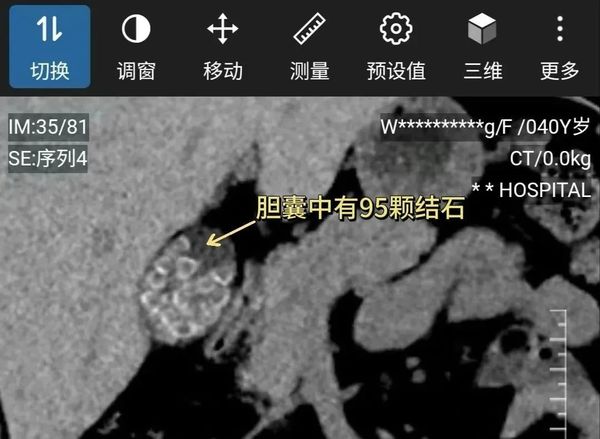 醫示警這類多發性膽結石可能會引發膽道阻塞、膽囊炎等。(圖/翻攝自廣州日報)