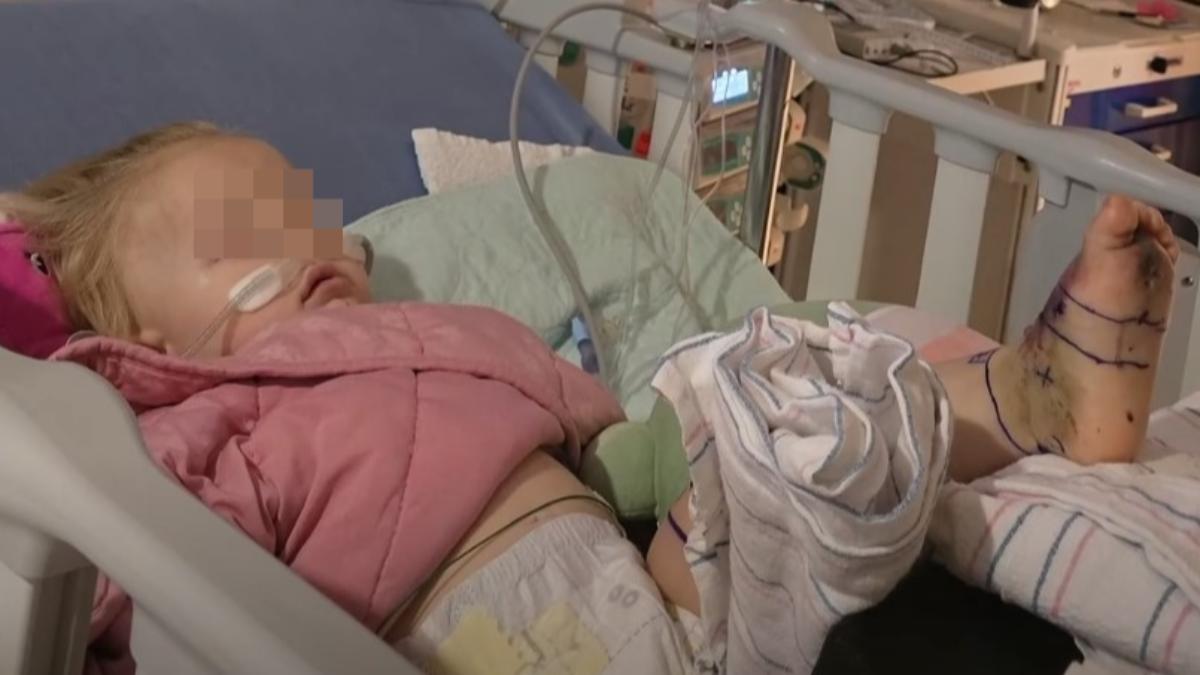 美1歲女童被響尾蛇咬 腳掌嚴重發黑「狂打30瓶血清」救命