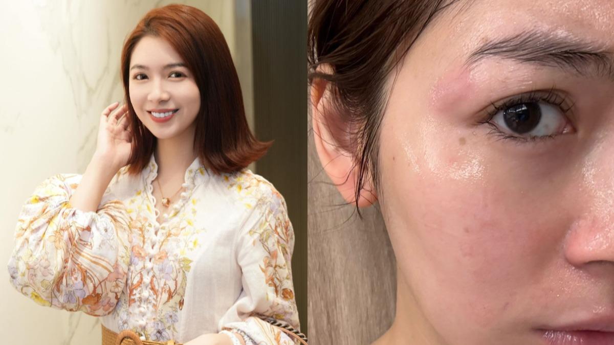 大馬女星「台灣髮廊遭燙傷」!200度捲髮棒重擊臉 怒控業者神隱